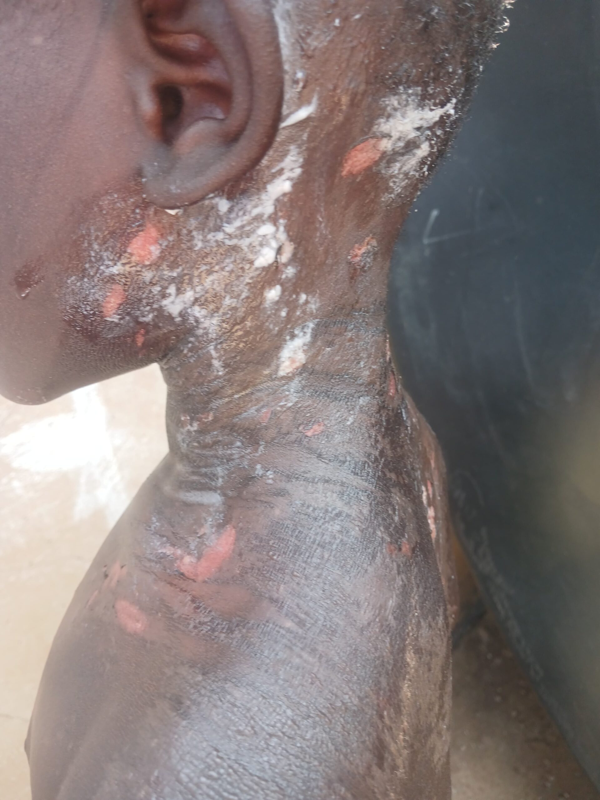Graphics Photo:Bondo Church Deacon arrested over alleged burning of four children during exorcism